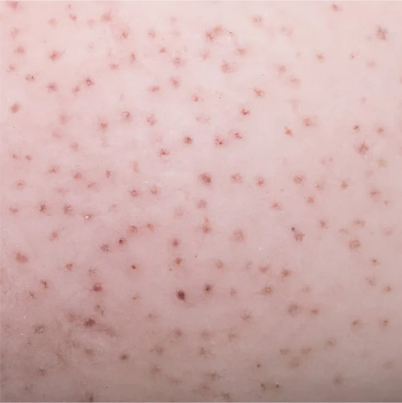 Everything You Need to Know About Red Bumps on Your Legs