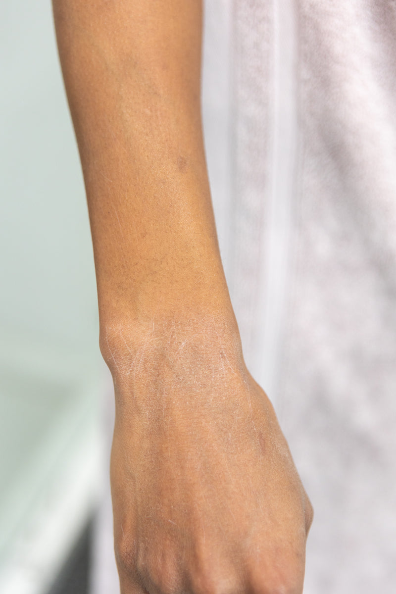 the most commonly misdiagnosed skin conditions