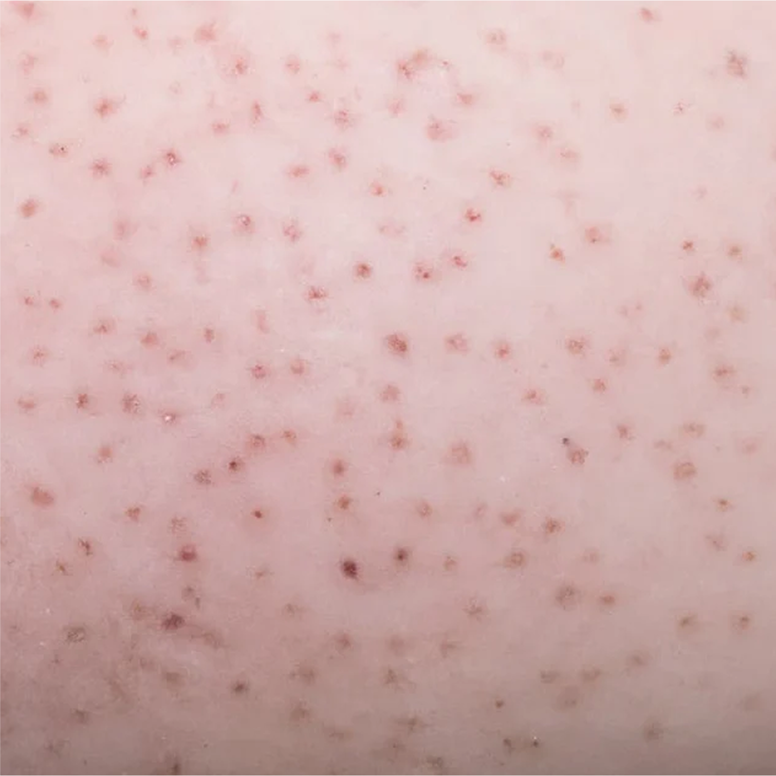 Bumpy Rash Behind Leg Everything You Need to Know About Red Bumps on Your Legs – hanni