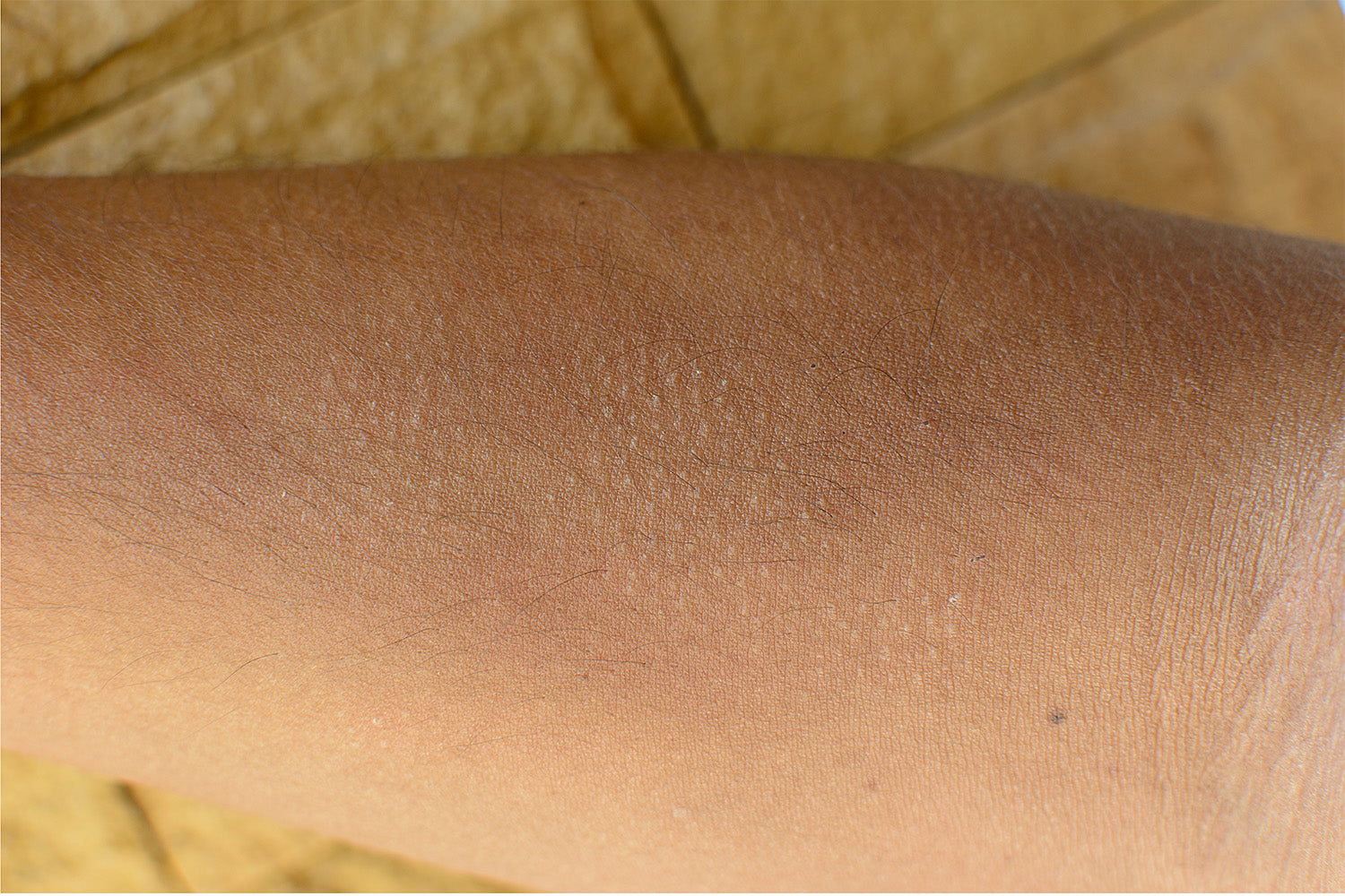 how to get rid of keratosis pilaris naturally