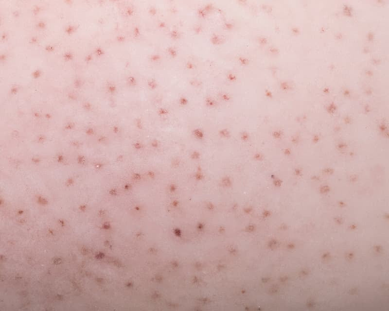 everything you need to know about red bumps on your legs